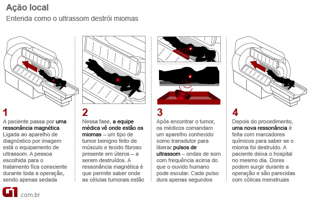 Instituto do Câncer de SP apresenta ultrassom capaz de destruir tumores