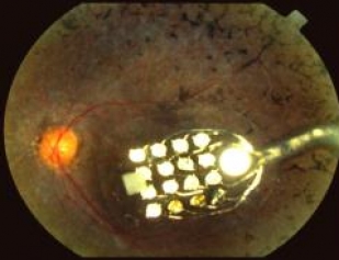 Britânico volta a enxergar com uso de olho biônico pioneiro