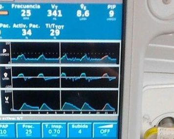 Empresa brasileira aprimora tecnologia de ventiladores pulmonares